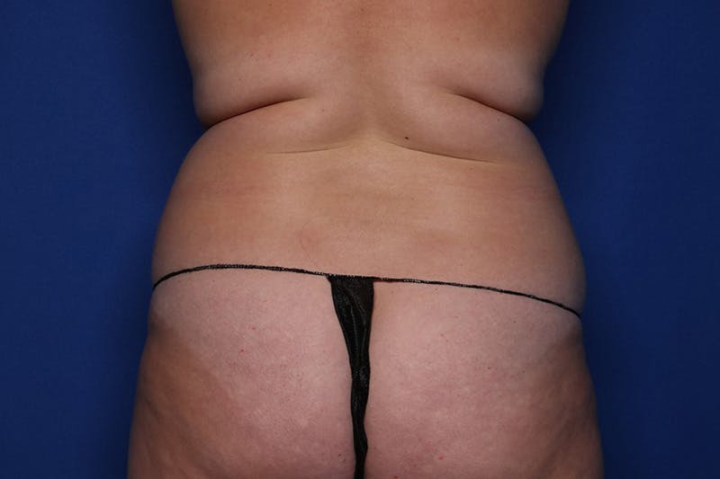 Liposuction Before & After Gallery - Patient 332847 - Image 3