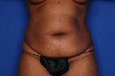 Tummy Tuck Before & After Gallery - Patient 413101 - Image 1