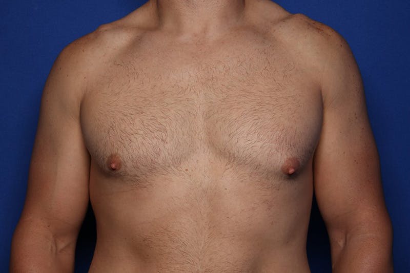 Gynecomastia (Male Breast Reduction) Before & After Gallery - Patient 168544 - Image 1