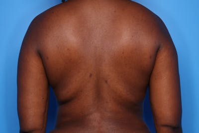 Liposuction Before & After Gallery - Patient 293890 - Image 2