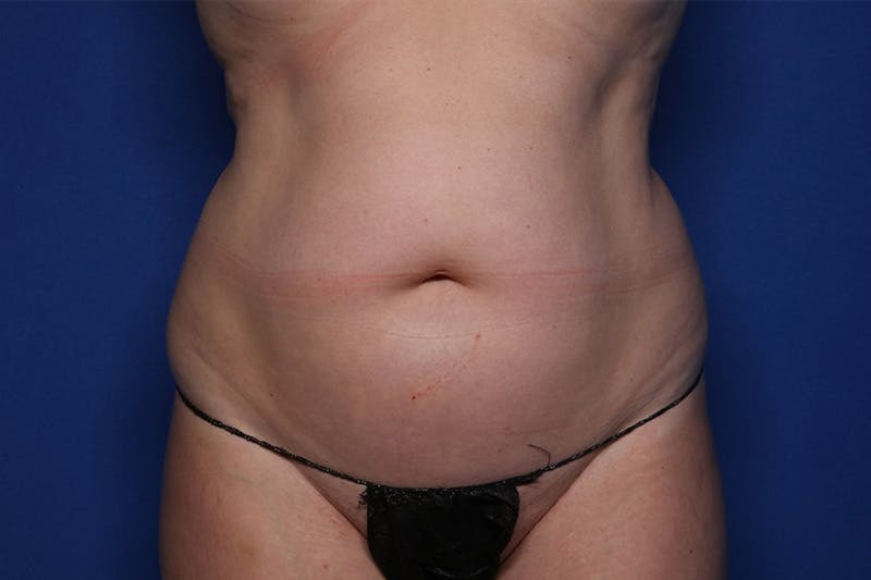 Liposuction Before & After Gallery - Patient 332847 - Image 1