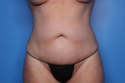 Liposuction Before & After Gallery - Patient 332847 - Image 2