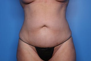 Liposuction Before & After Gallery - Patient 332847 - Image 2