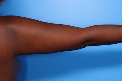 Arm Lift Before & After Gallery - Patient 158887 - Image 2