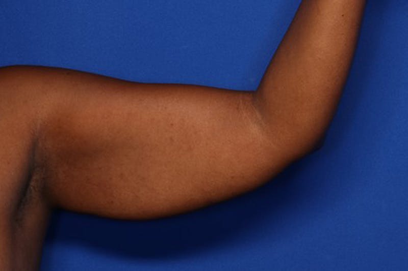 Arm Lift Before & After Gallery - Patient 158887 - Image 3