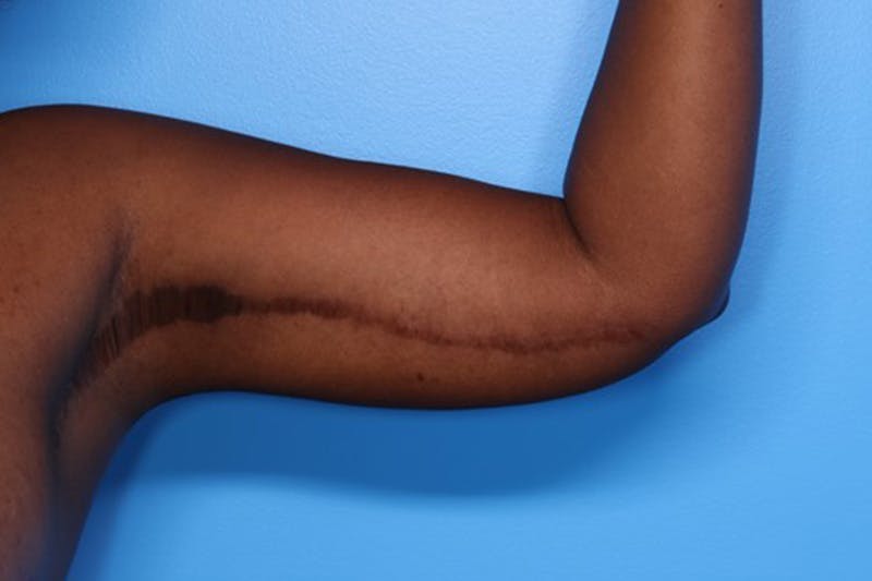 Arm Lift Before & After Gallery - Patient 158887 - Image 4