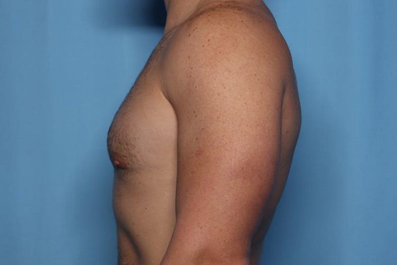 Gynecomastia (Male Breast Reduction) Before & After Gallery - Patient 168544 - Image 4