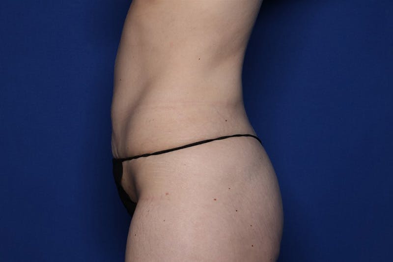 BodyTite™ Before and After Before & After Gallery - Patient 122642 - Image 4