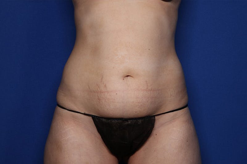BodyTite™ Before and After Before & After Gallery - Patient 122642 - Image 1