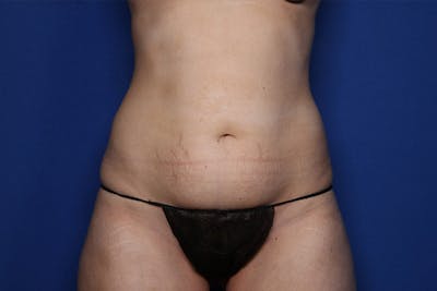 BodyTite™ Before and After Before & After Gallery - Patient 122642 - Image 1