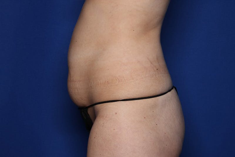 BodyTite™ Before and After Before & After Gallery - Patient 122642 - Image 3