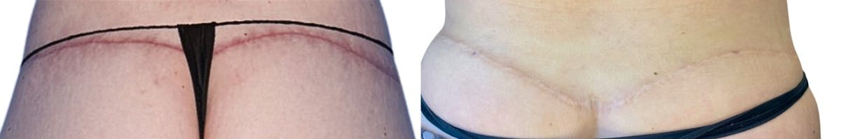 SkinPen® Microneedling Before & After Gallery - Patient 282527 - Image 2