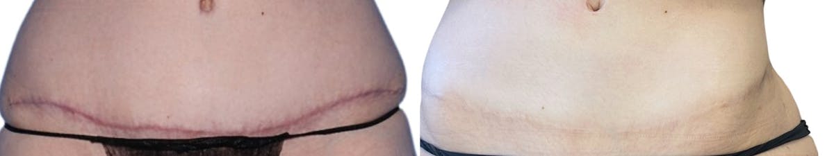 SkinPen® Microneedling Before & After Gallery - Patient 282527 - Image 1