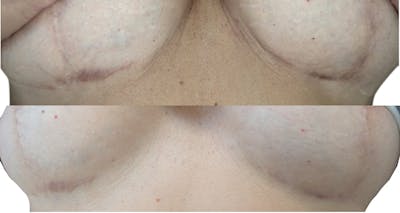 Sciton® BBL Hero Before & After Gallery - Patient 394631 - Image 1