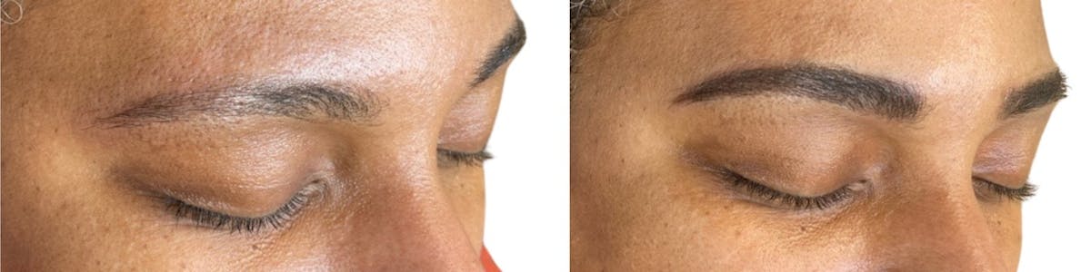 Eyebrow Microblading Before & After Gallery - Patient 358108 - Image 2