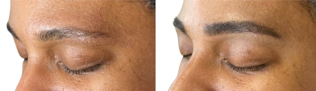 Eyebrow Microblading Before & After Gallery - Patient 358108 - Image 1
