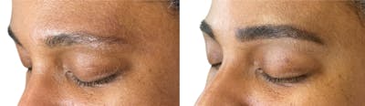 Eyebrow Microblading Before & After Gallery - Patient 358108 - Image 1