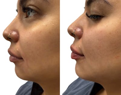 Chin Filler Before & After Gallery - Patient 400889 - Image 1