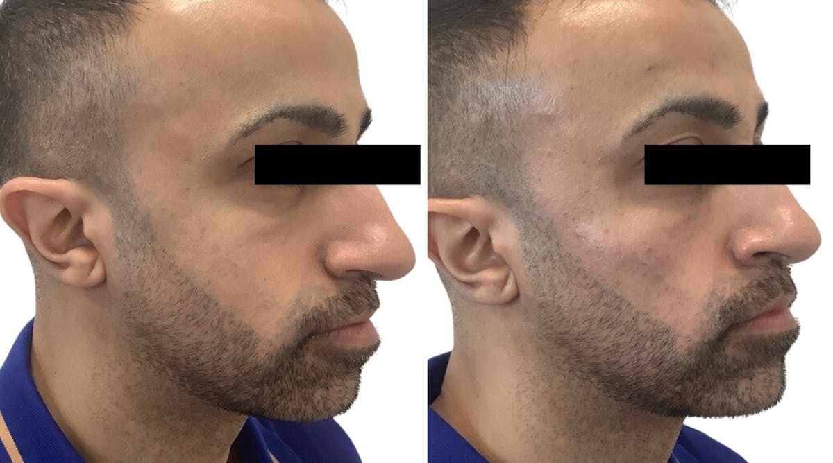 Cheek Filler Before & After Gallery - Patient 217986 - Image 3