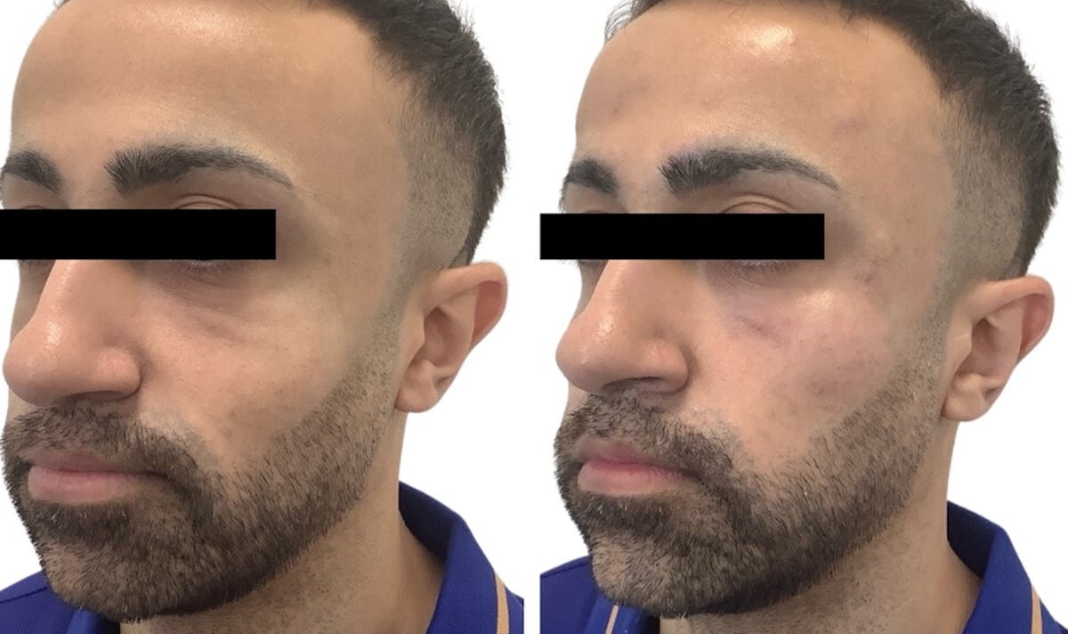 Cheek Filler Before & After Gallery - Patient 217986 - Image 1
