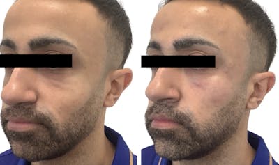Chin Filler Before & After Gallery - Patient 735106 - Image 1