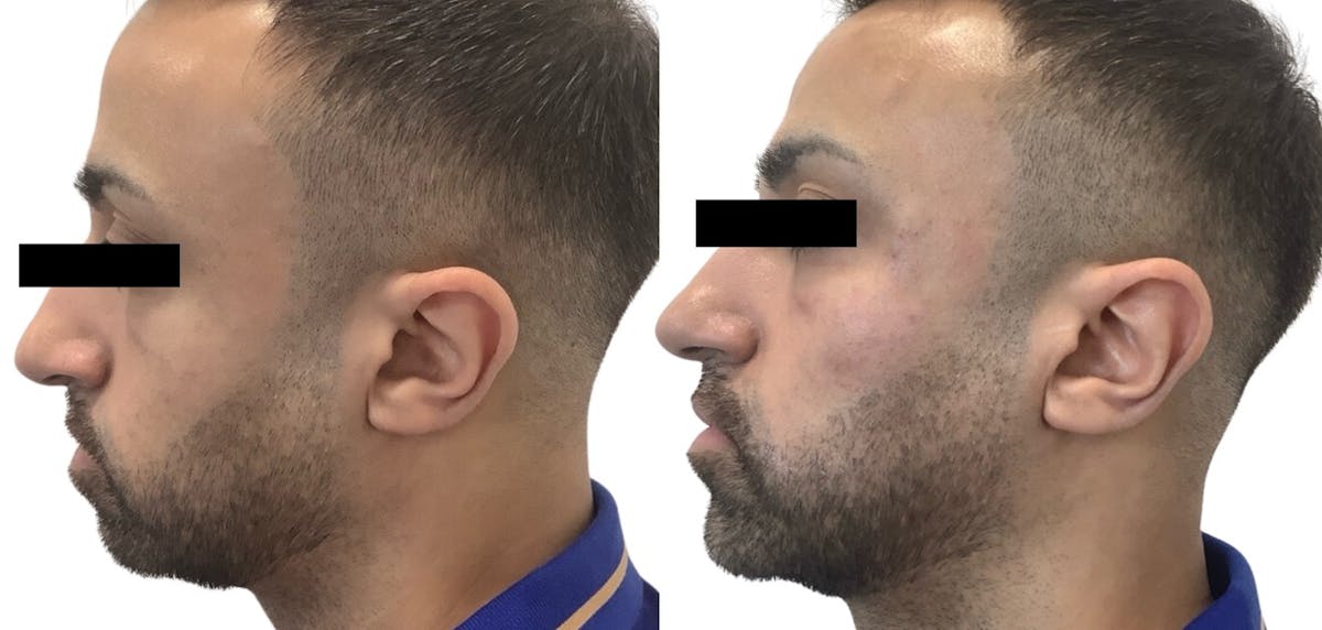 Cheek Filler Before & After Gallery - Patient 217986 - Image 2