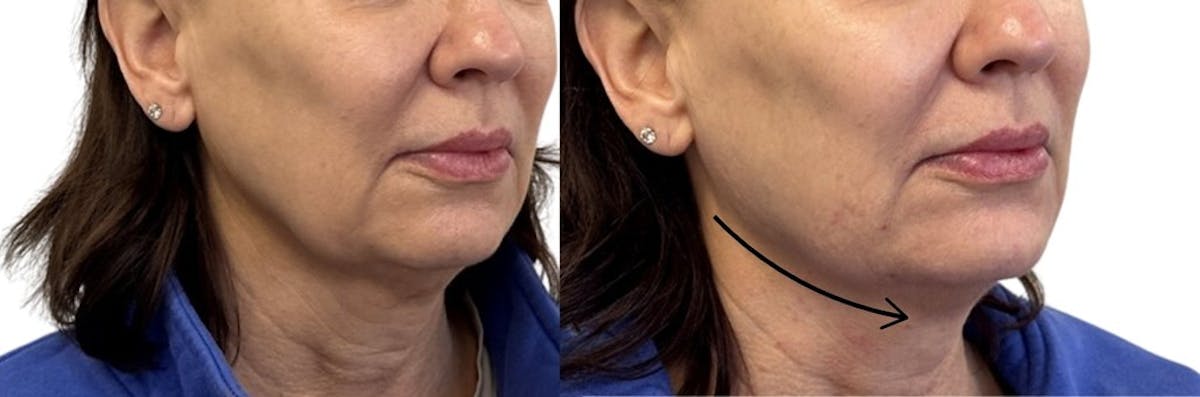 Jawline Filler Before & After Gallery - Patient 372149 - Image 2