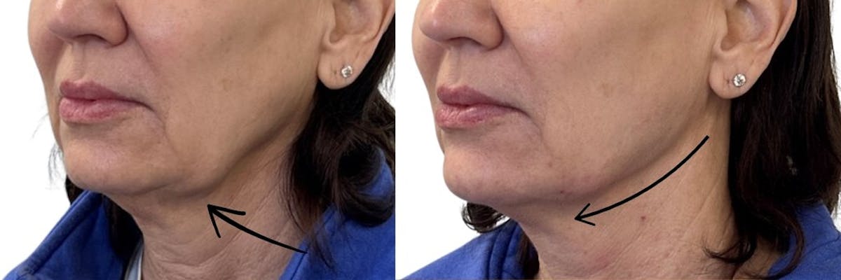 Jawline Filler Before & After Gallery - Patient 372149 - Image 1