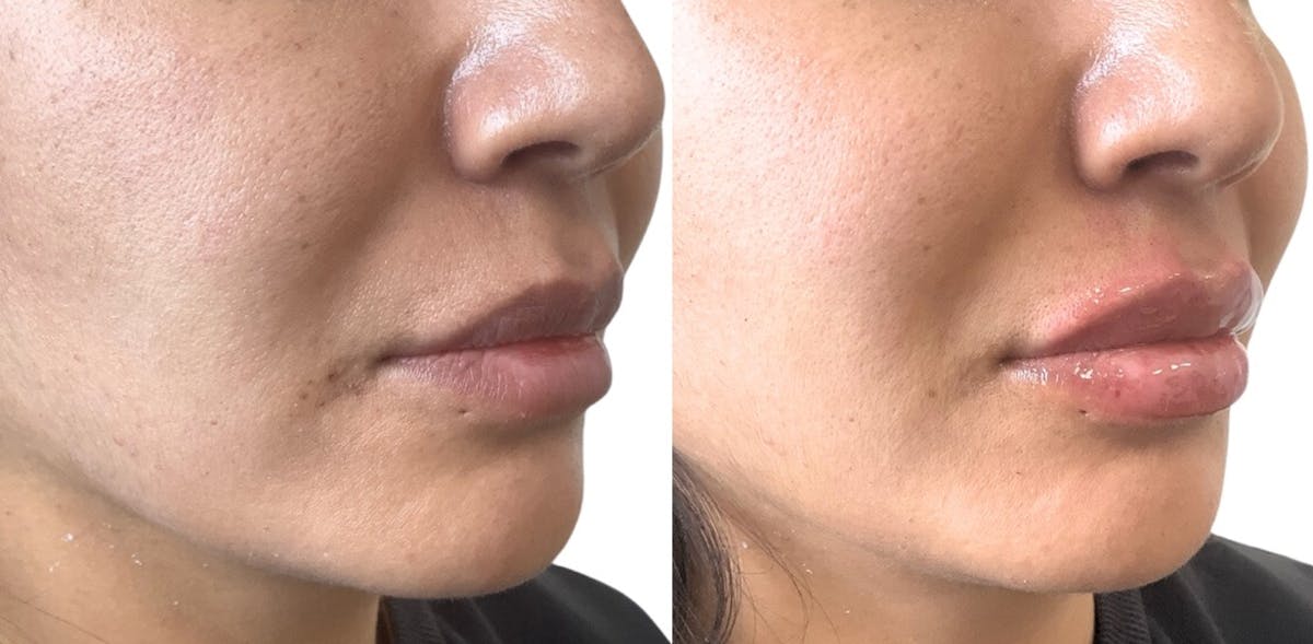 Juvéderm® Before & After Gallery - Patient 197149 - Image 1