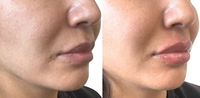 Juvéderm® Before & After Gallery - Patient 197149 - Image 1