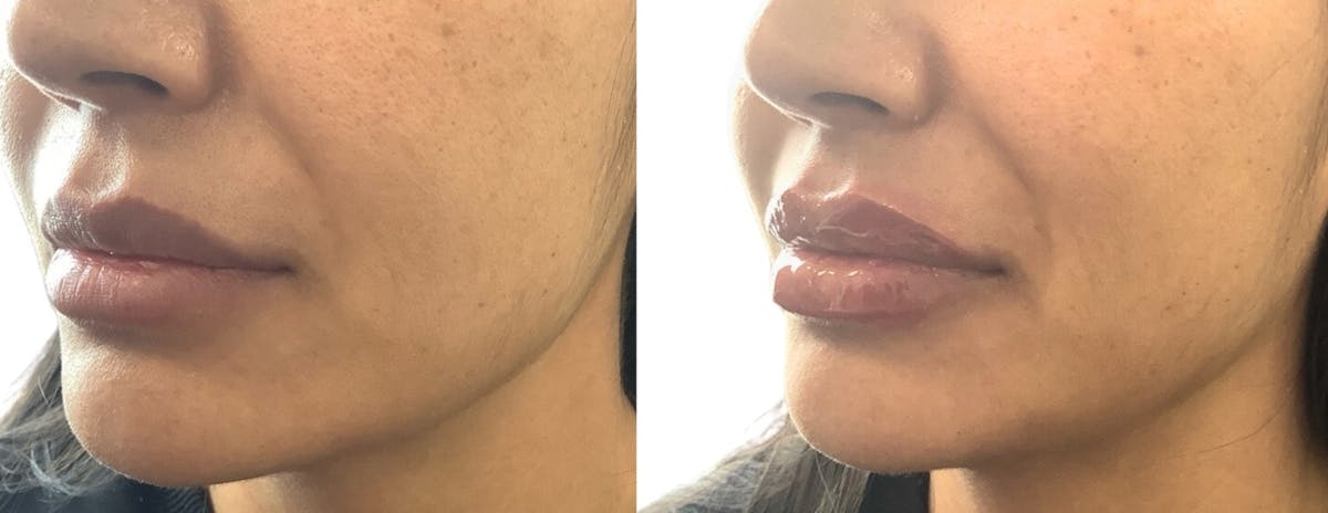 Juvéderm® Before & After Gallery - Patient 197149 - Image 3