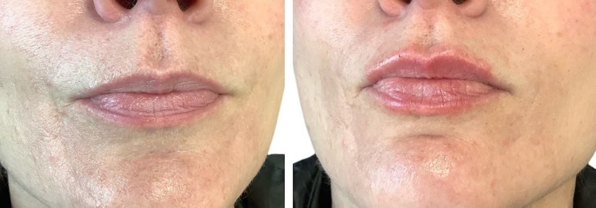 Juvéderm® Before & After Gallery - Patient 185381 - Image 1