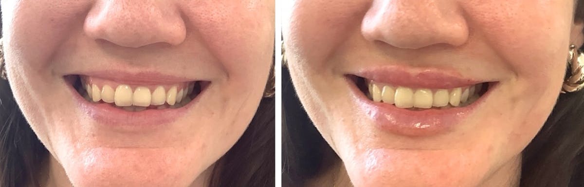 Lip Filler Before & After Gallery - Patient 276831 - Image 2