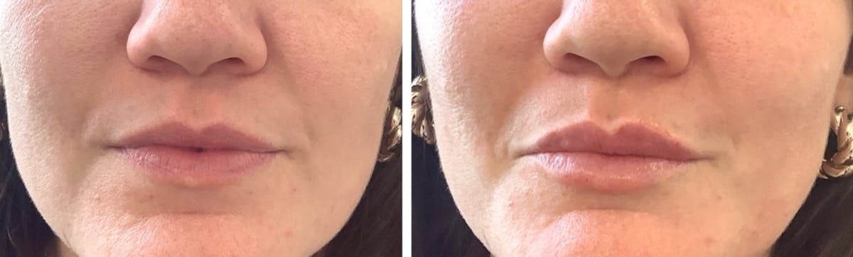 Lip Filler Before & After Gallery - Patient 276831 - Image 1