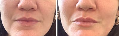 Lip Filler Before & After Gallery - Patient 276831 - Image 1