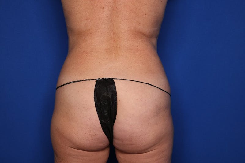 BodyTite™ Before and After Before & After Gallery - Patient 114749 - Image 5