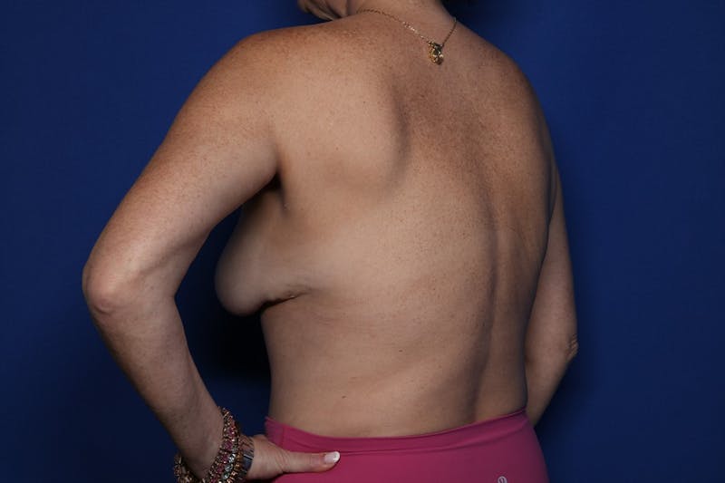 Bra Line Lift Before & After Gallery - Patient 222748 - Image 5