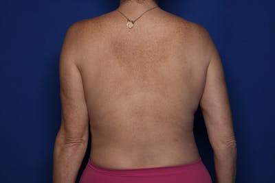 Bra Line Lift Before & After Gallery - Patient 222748 - Image 1
