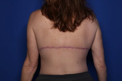 Bra Line Lift Before & After Gallery - Patient 222748 - Image 2