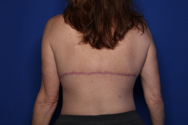 Bra Line Lift Before & After Gallery - Patient 222748 - Image 2