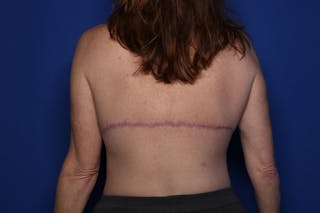 Bra Line Lift Before & After Gallery - Patient 222748 - Image 2