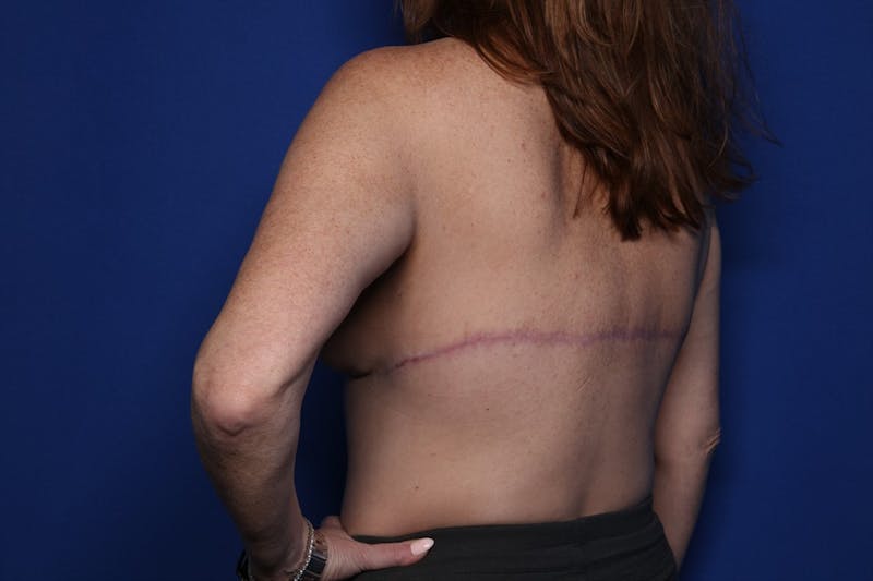 Bra Line Lift Before & After Gallery - Patient 222748 - Image 6