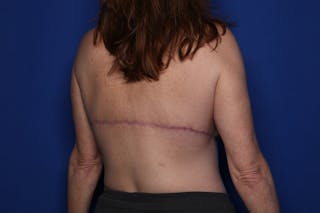 Bra Line Lift Before & After Gallery - Patient 222748 - Image 4