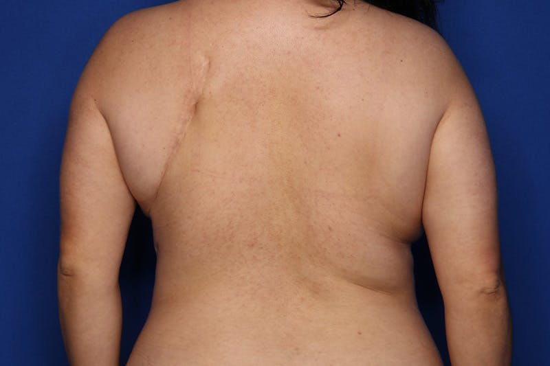 Mommy Makeover Before & After Gallery - Patient 371107 - Image 5