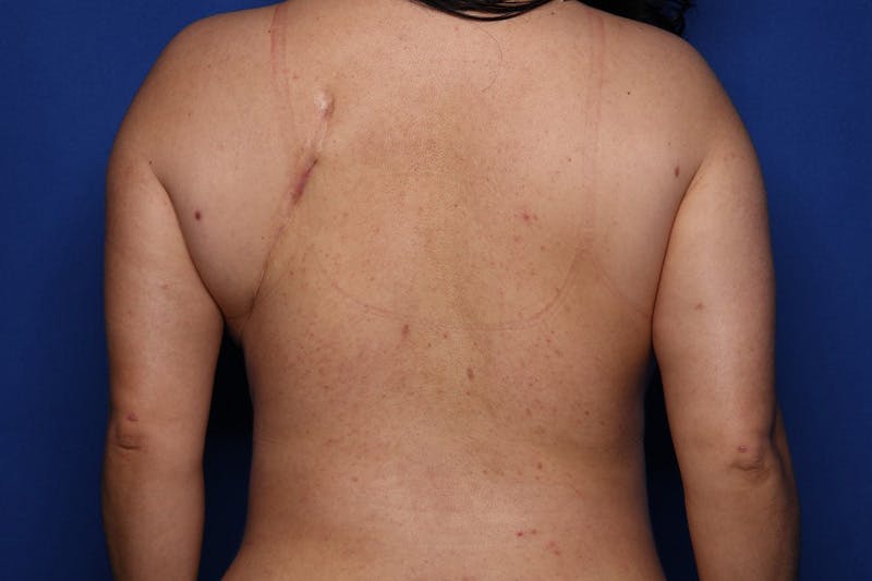 Mommy Makeover Before & After Gallery - Patient 371107 - Image 6