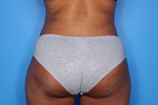 Tummy Tuck Before & After Gallery - Patient 417269 - Image 8