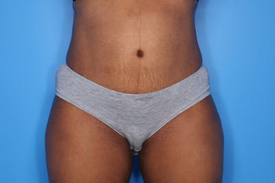 Tummy Tuck Before & After Gallery - Patient 417269 - Image 2