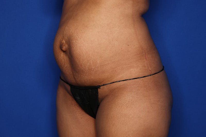 Tummy Tuck Before & After Gallery - Patient 417269 - Image 3