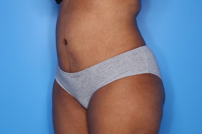 Tummy Tuck Before & After Gallery - Patient 417269 - Image 4