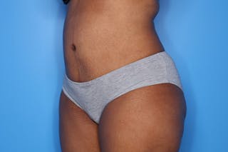 Tummy Tuck Before & After Gallery - Patient 417269 - Image 4